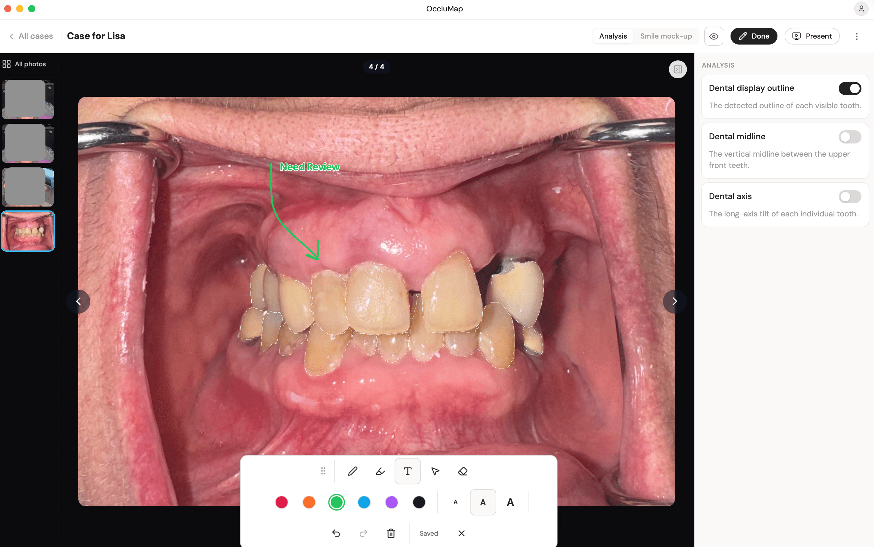 OccluMap: Outline, midline and axis, drawn directly on the photo.